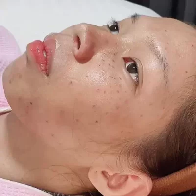 Ủ trắng có tác dụng làm mờ vết nám thâm tàn nhang