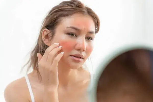 Da bị cháy nắng làm sao để trắng lại? 2 Làn da bị cháy nắng