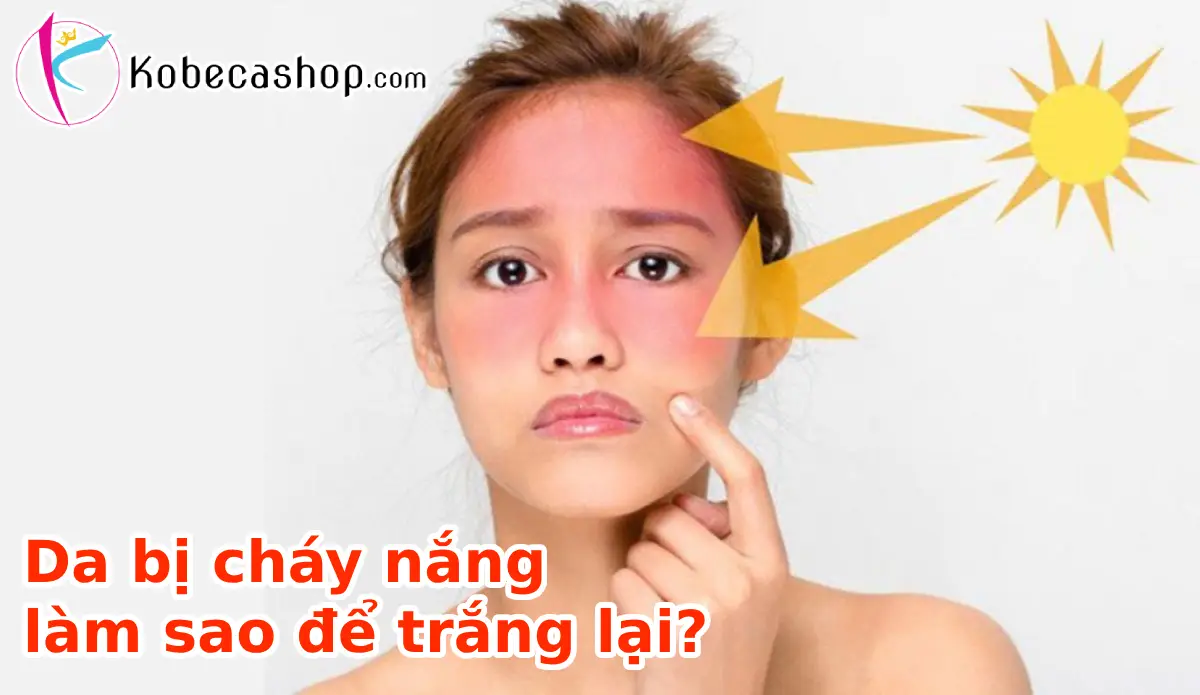 Da bị cháy nắng làm sao để trắng lại? 1 Da bị cháy nắng làm sao để trắng lại