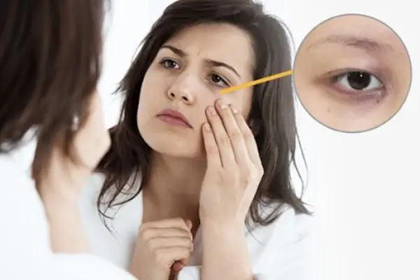 Nguyên nhân gây thâm quầng mắt 3 Di truyền là nguyên nhân gây thâm quầng mắt