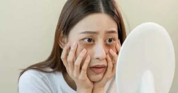 Nguyên nhân gây thâm quầng mắt 5 Do ăn mặt là nguyên nhân gây thâm quầng mắt