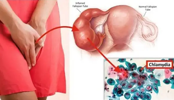 Bệnh Chlamydia