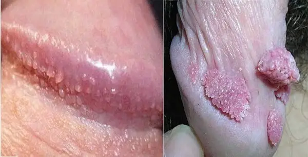 Sùi mào gà