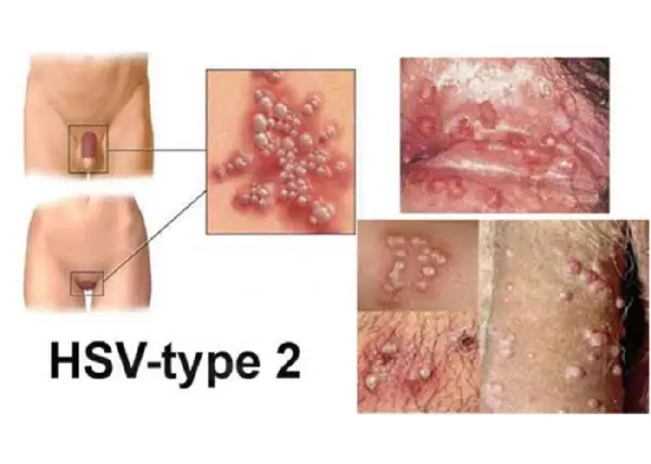 Herpes sinh dục